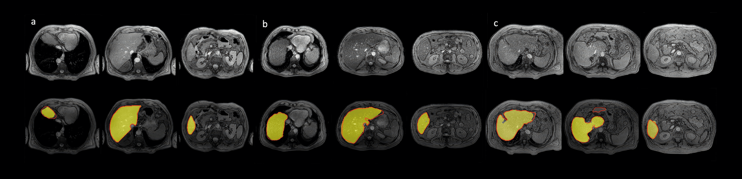 Segmentos del hígado: Figura Imagen Enfermedad hepática avanzada 