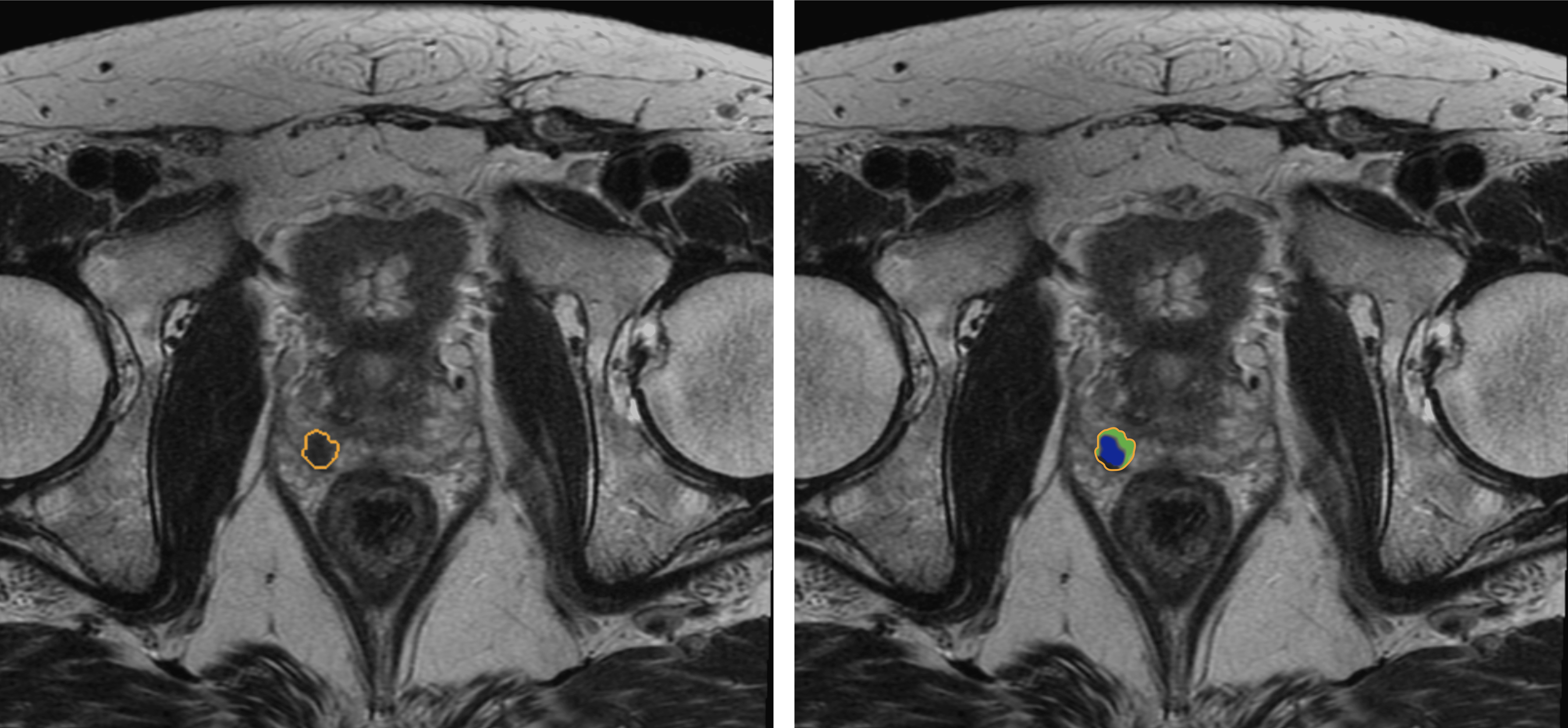 MRI Detection of Prostate Cancer 