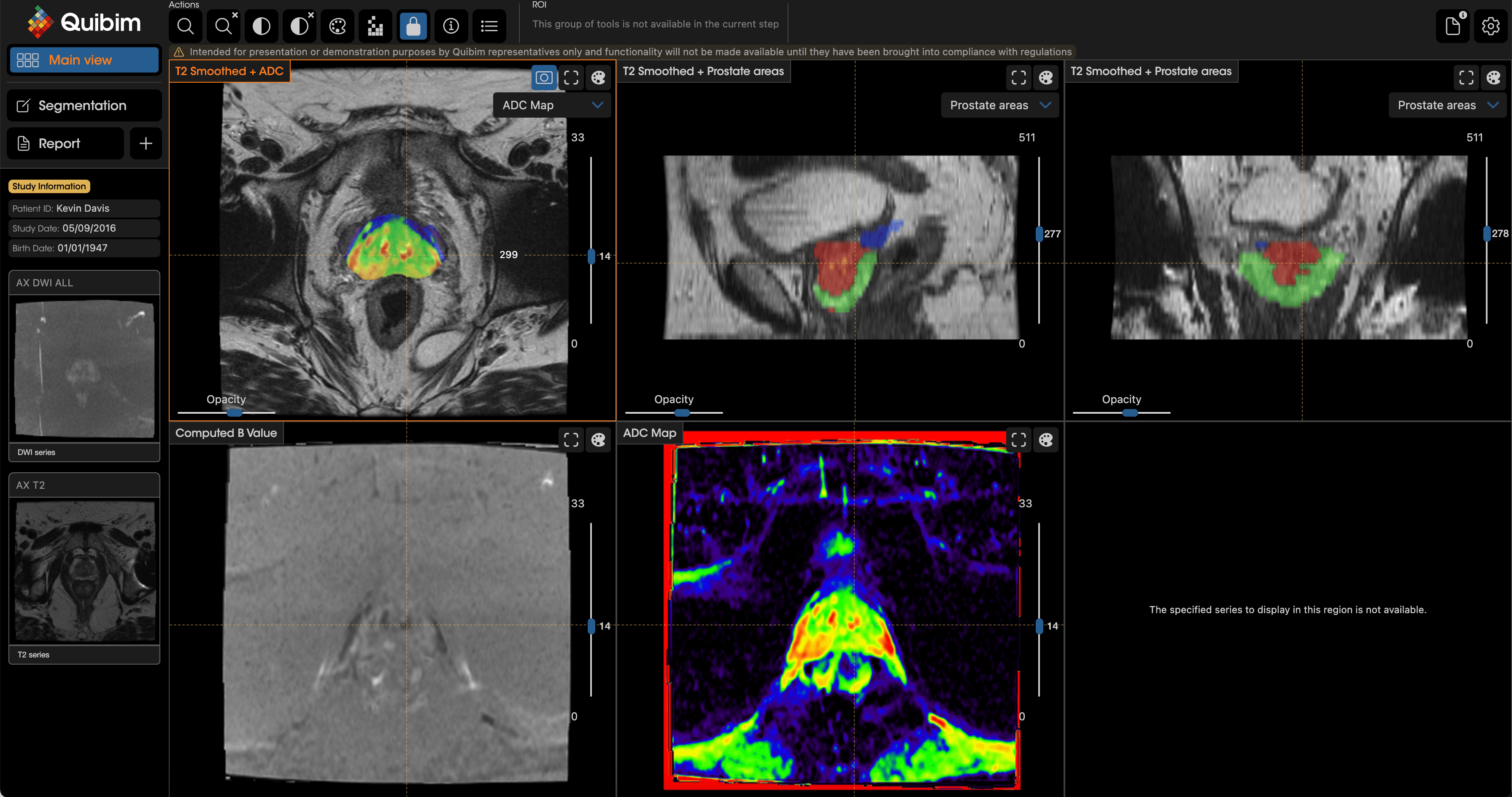 MRI Detection of Prostate Cancer 