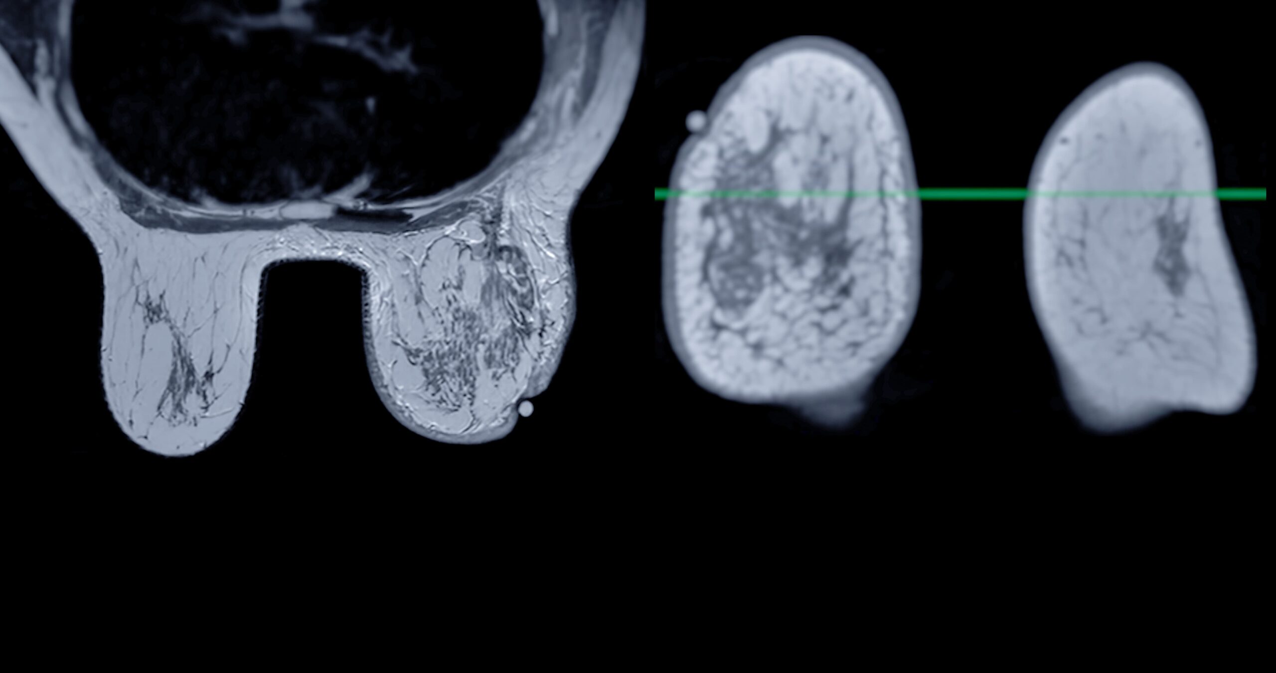 Ai breast cancer